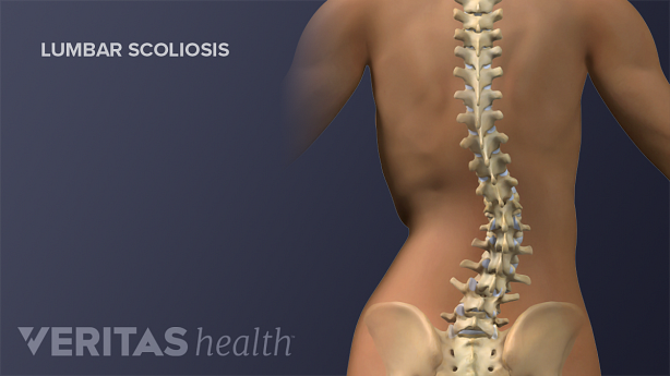 Illustration of a adult spine showing scoliosis.
