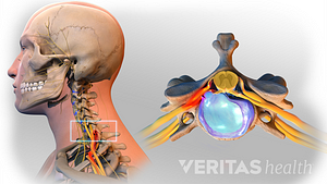 Profile and superior views of herniated discs in the cervical spine.