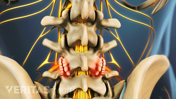 An illustration showing osteoarthritis of the lumbar spine.