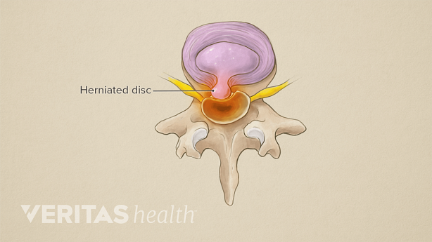 An illustration showing lumbar herniated disc.