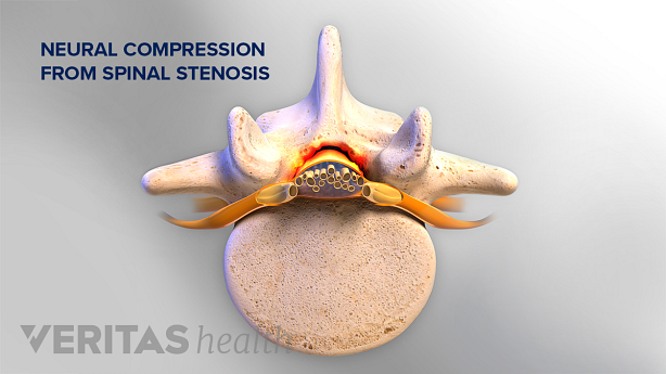 Illustration showing lumbar vertebra with stenosis.