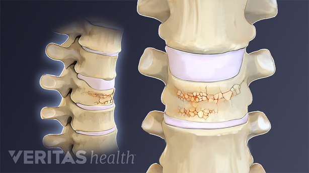 Illustration showing vertebral fracture