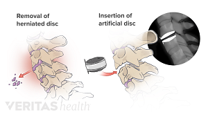 Illustration showing removal of herniated cervical disc and insertion of an artificial disc